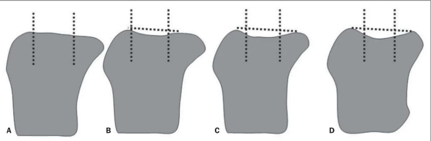 Figure 1. Grade 0 (normal) (A), grade 1 (mild) (B), grade 2 (moderate) (C), grade 3 (severe) (D)