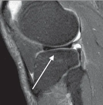 Figure 2. Grade 0 (normal). Sagittal MRI of knee, T2-weighted image with fat saturation, with no sign of structural alterations.