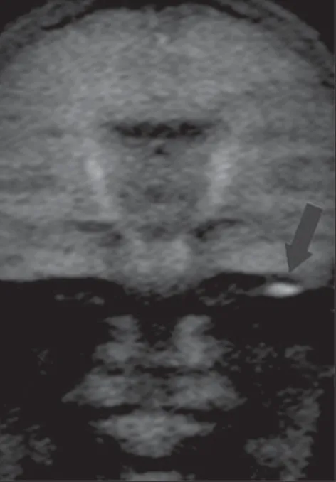 Figure 1B. MRI, coronal plane, HASTE diffusion- diffusion-weighted (non echo-planar) sequence