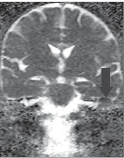 Figure 3B. ADC map of the same case confirming diffusion restriction (arrow).