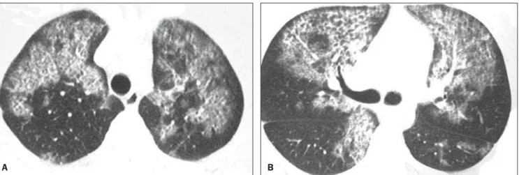 Figure 2. HRCT at two different levels showing the crazy paving pattern. Areas of ground-glass attenuation and intralobular septal thickening are observed in association with areas of focal sparing.