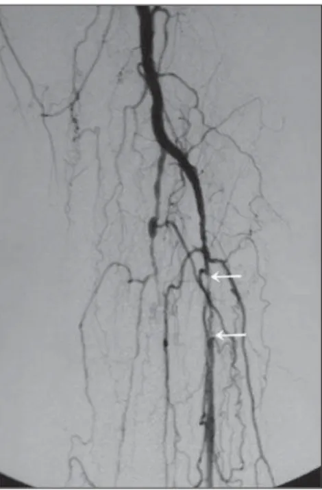 Figure 1. Segmental occlusion of the left anterior tibial artery (arrows). Observe the absence of  opaci-fication of the fibular and posterior tibial arteries.