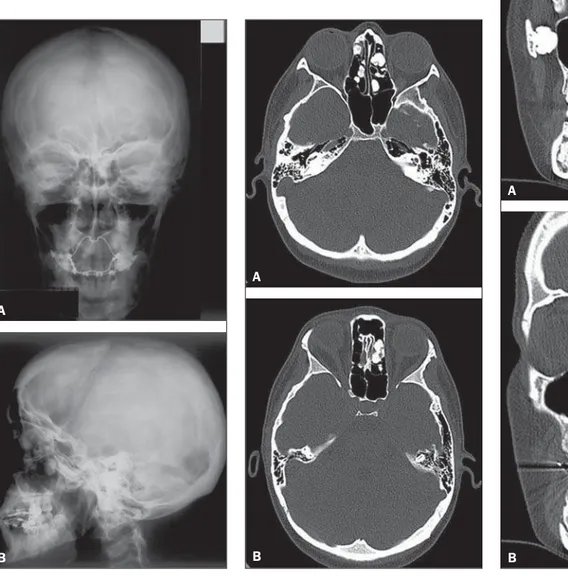 Figure 2. Non-contrast-enhanced CT, bone window.