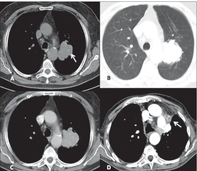 Figure 3. Typical carcinoid tumor. Axial chest CT images show the presence of a lung mass with lobulated contours medially located in the upper left lobe (mediastinal window on A and lung window on B), with homogeneous density and containing subtle calcifi