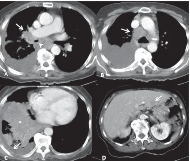 Figure 6. Small-cell lung cancer. Characteristic lesion identified on contrast-enhanced chest CT with mediastinal window