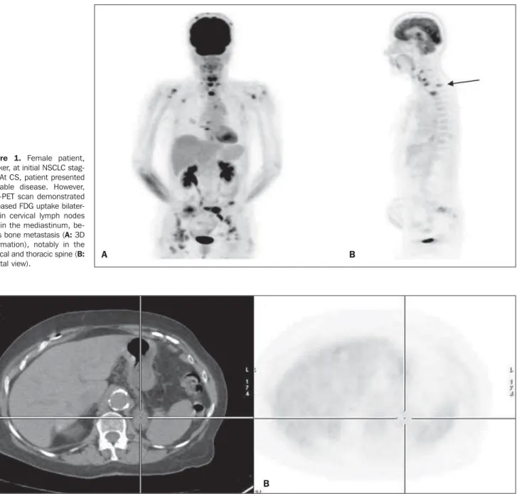 Figure 2. Male patient, smoker, at initial NSCLC staging. At CS, patient presented inoperable disease