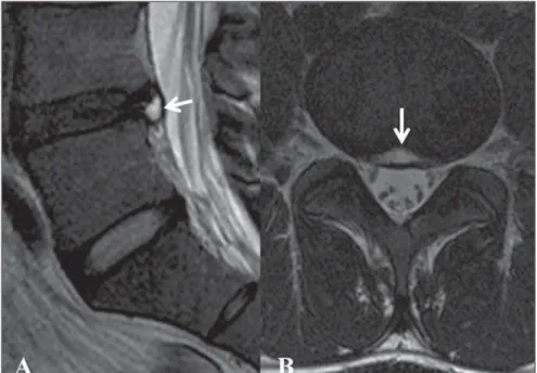 Figure 1. Sagittal MRI T2-weighted (A) and axial MRI T2-weighted (B) images of case 3 showing a high- high-signal oval shaped cyst in the anterior epidural space, centrally located in contiguity with a disrupted annulus fibrosus (arrows).