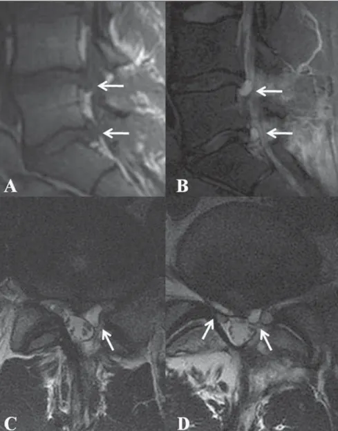 Figure 4. Sagittal MRI T1- and T2-weighted images (A,B), axial MRI T2-weighted image at L4-L5 level (C) and L5-S1 level of case 4 showing double postsurgical pseudocysts related to discs at both levels (white arrows).