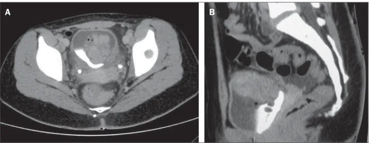 Figure 2. A: Axial computed tomography of pelvis after intravenous contrast injection (excretory phase) showing expansile, heterogeneous, lobulated lesion on the upper vesical wall, with heterogeneous enhancement and blurring of the adjacent fat