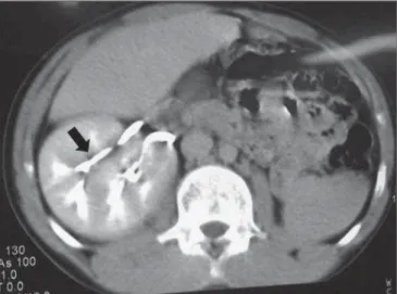 Figure 1. Computed to- to-mography showing the presence of right-sided renal ectopia located in the lower pelvis, in  asso-ciation with absence of the left kidney and  com-plete renal fusion with drainage by two distinct ureters.