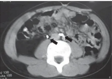 Figure 2. Computed to- to-mography demonstrating right-sided renal fusion drained by two distinct ureters..