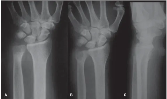 Figure 2. MRI of right wrist. A,B: Coronal and axial T1-weighted images demonstrate intermediate signal intensity in the distal ulna bone marrow, with cortical destruction and fistulous traject