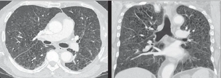 Figure 4. Chest computed tomography of the patient demonstrating multiple cysts diffusely scattered throughout the lung parenchyma, with irregular walls and variable dimensions (bizarre cysts) in association with diffuse micronodules, a typical pattern of 