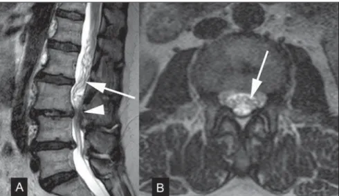 Figure 3. Surgically confirmed spinal arteriovenous fistula. A,B: