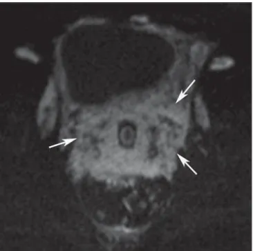 Figure 4. MRI. Diffusion-weighted, short-axis image demonstrates diffusion restriction (arrows), indicating the presence of a lesion with high cellularity.