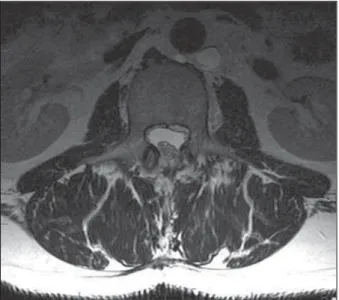 Figure 3. Axial T2WI 60 days after surgery demonstrates  sig-nificant improvement of the compression of the cauda equina roots and the abscence of any residual disc in the  epi-dural space.