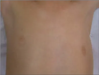 Figure 1. Asymmetry of the axillary folds and left nipple depression.