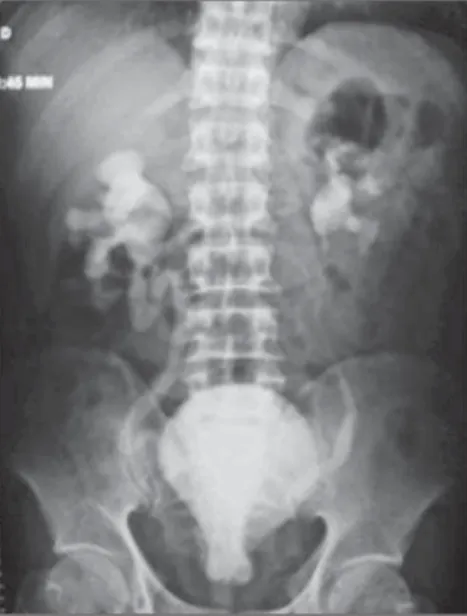 Figure 1. Excretory urography demonstrating the finding of moderate bilateral hydronephrosis and