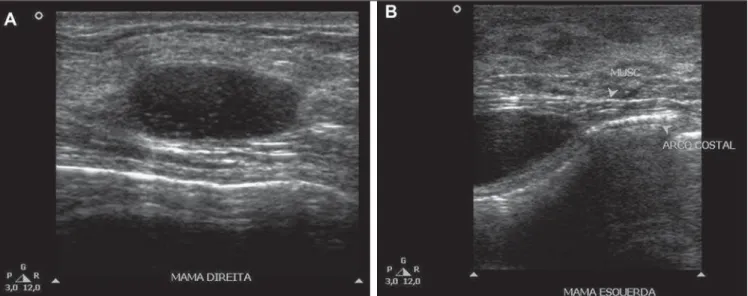 Figure 3. Breast magnetic resonance imaging. Axial sections demonstrating the presence of hyperintense collections on T2-weighted (A) and hypointense collections on T1-weighted (B) images.