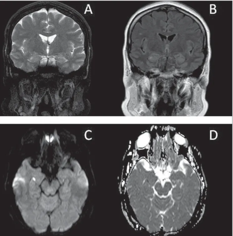 Figure 1. MRI of brain. Coronal, T2-weighted (A), FLAIR (B), diffusion-weighted (C) and ADC map (D) images.
