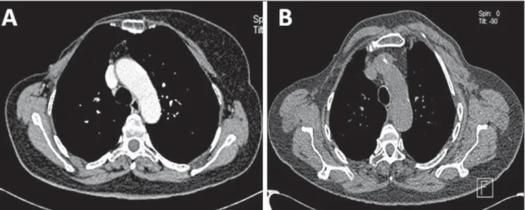 Figure 1. Postoperative appearance of chest wall at MSCT. A: Axial image of total radical mastectomy demonstrating chest wall asymmetry, and absence of both pectoralis major and minor muscles at right
