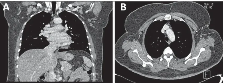 Figure 6. Lymph node compromise. Coronal (A) an axial (B) MSCT images demonstrating axillary lymph nodes bilaterally, some of them with increased diam- diam-eter.