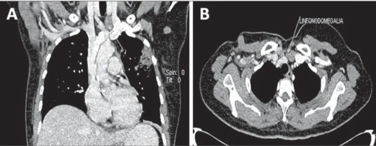 Figure 7. Lymph node compromise. Coronal (A) and axial (B) MSCT images demonstrating supraclavicular and axillary lymph nodes enlargement at left.