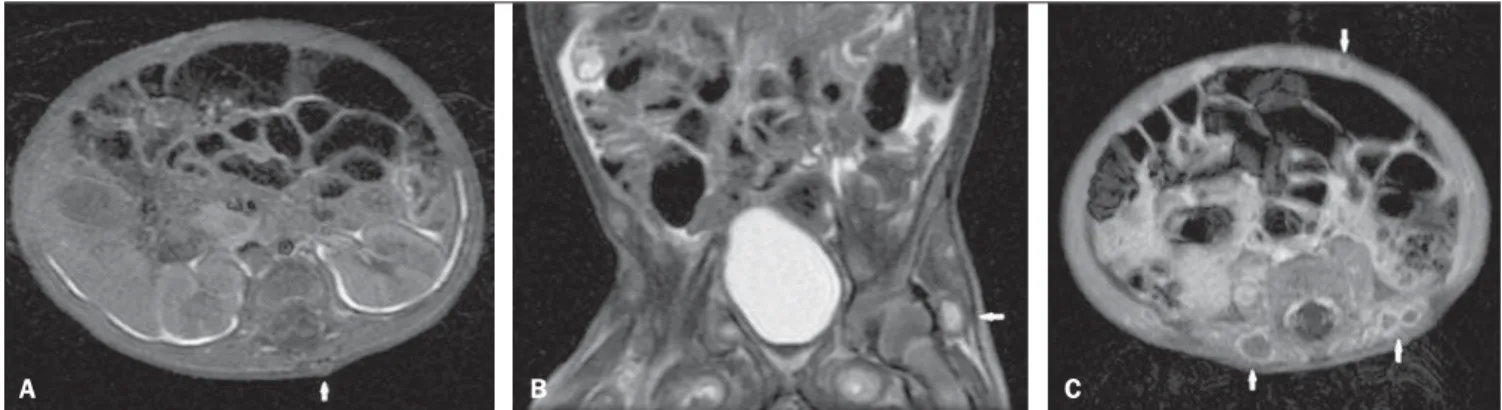 Figure 4. Magnetic resonance imaging. A: Axial T1-weighted image demonstrates dorsal nodule with iso/hyposignal