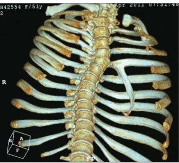 Figure 2. Computed tomography 3D reconstruction demonstrating vertical bone image joining the fourth rib posteriorly at left.