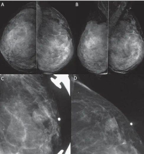 Figure 2. Breast ultrasonography demonstrating a complex cyst with solid components and thickened septa located in the superolateral quadrant of the left breast, peripherically to the papilla, measuring 13 × 8 mm, in a region of palpation at physical exami