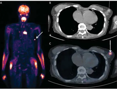 Figure 3. PET/CT image revealing anomalous uptake of  18 F-FDG on a mass in left breast (arrow) with maximum SUV = 4.90 and also in other extramammary sites