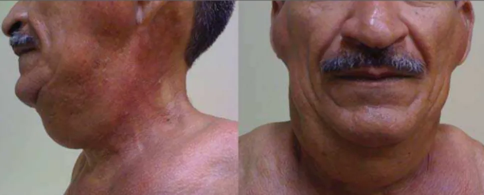 Figure 1. Lateral and frontal views of the patient demonstrating symmetrical enlargement of soft tissues resulting from fat deposition.