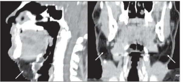 Figure 2. Sagittal and coronal reconstructions demonstrating deep and diffuse deposition of adipose tissue (arrows).