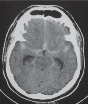 Figure 1. Cranial computed tomography revealing diffuse Fisher grade 3  subarach-noid hemorrhage and subtle ectasia of the temporal horns of lateral ventricles.
