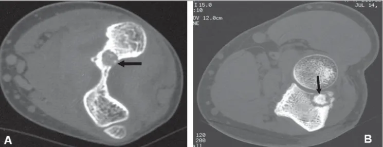 Figure 5. Nidus appearance at tomography. A: Partially calcified osteolytic lesion (arrow), smaller than 1 cm, adjacent to the olecranon fossa