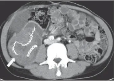 Figure 1B. Pre-contrast axial CT section of the abdomen demonstrating a mass with soft tissue density with hyperdense serpiginous structures inside (arrow).