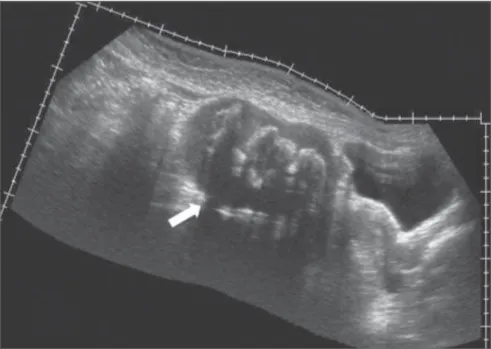 Figure 2. Male, one-year-old patient submitted to surgical correction of imperforate anus,  progress-ing with pain and bulgprogress-ing in the right iliac fossa in the late postoperative period