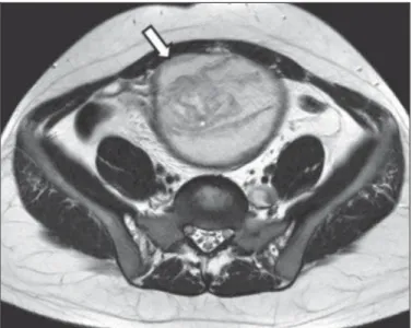 Figure 3F. Paramedian sagittal, contrast-enhanced abdominal MRI, T1-weighted section  demonstrat-ing the capsular reinforcement of the lesion (arrow).