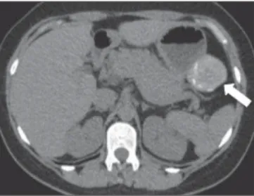 Figure 5A. Female, 53-year-old patient presenting a palpable mass in the mesogastric region