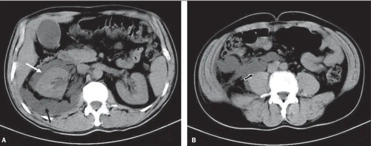 Figure 1. A: Computed tomography demonstrating the presence of isodense biliary dilation and collections in the perirenal (white arrow) and retroperitoneal (black arrow) spaces, both at right