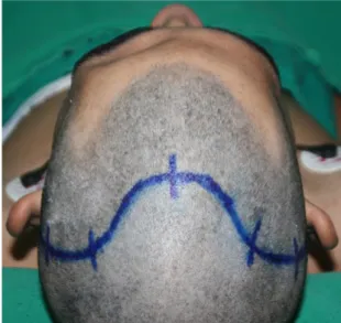 Figura  5.  Vista  do  paciente  com  afundamento  do  osso  frontal,  após  incisão  e  descolamento  periosteal,  com  visão  direta  da  fratura  (seta)