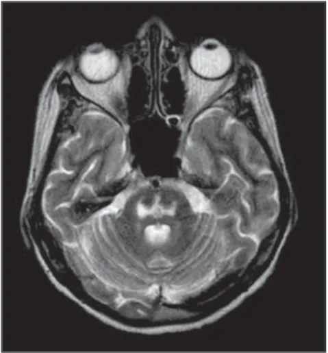 Figure 3. Magnetic resonance imaging, axial plane: