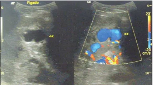 Figure 1. Doppler ultrasonography demonstrating a dilated and tortuous structure with 2 cm in diam- diam-eter, and presence of flow in the liver segments V and VI.