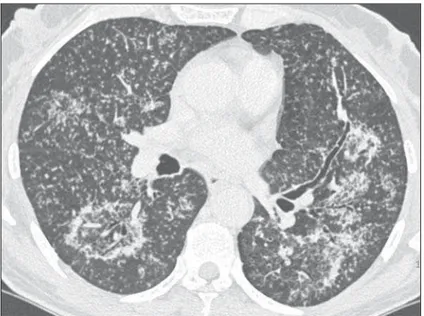 Figura 1. Tomografia computadorizada de alta resolução, com corte nas regiões pulmo- pulmo-nares inferiores.