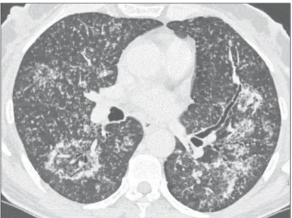 Figure 1. High-resolution computed tomography, lower pulmonary regions section.