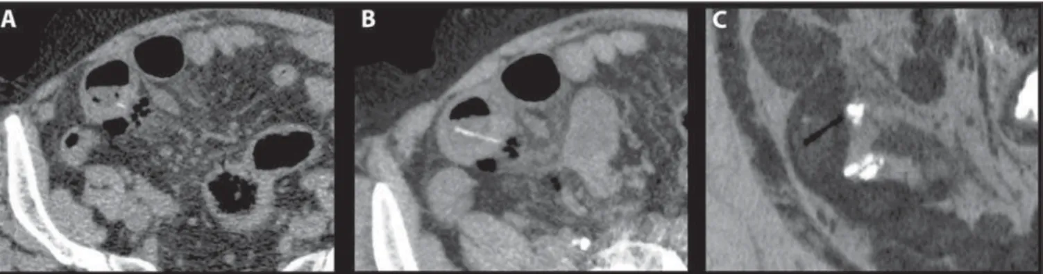 Figure 1. Patient 1. Non-contrast-enhanced axial CT image (A) shows a small linear hyperdensity within a thickened ileal bowel in association with extraluminal air and minor infiltration of surrounding fat (this FB was originally missed at the first analys