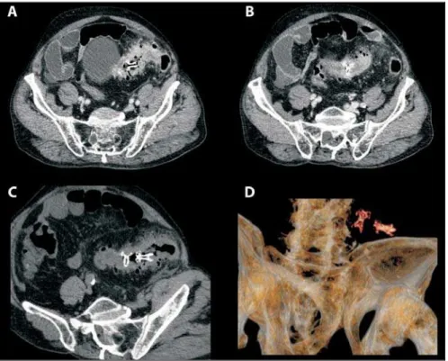 Figure 2. Patient 2. Axial (A,B) contrast-enhanced CT scan at two different levels depicts two intraluminal hyperdense FB (chicken bones) in the sigmoid colon, which demonstrates mural thickening with marked enhancement and discreet surrounding fat strandi