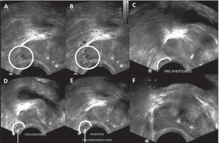 Figure 1. Ultrasonography with a step-by-step description of local anesthesia for prostate biopsy by means of periprostatic nerve block