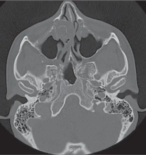 Figura 14. TC com reconstrução coronal para par- par-tes moles. Aumento volumétrico da concha nasal média direita secundário à presença de mucocele no interior da pneumatização da concha.