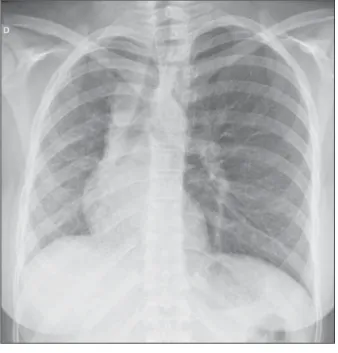 Figure 1. Chest radiography demonstrating right lung with reduced dimensions and  ipsilat-eral mediastinal deviation.